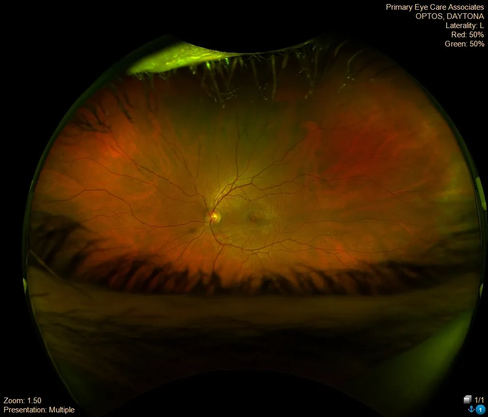 Fundus photograph, left eye (2021)