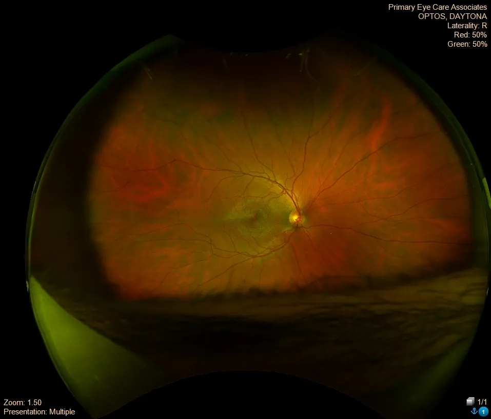 Fundus photograph, right eye (2021)